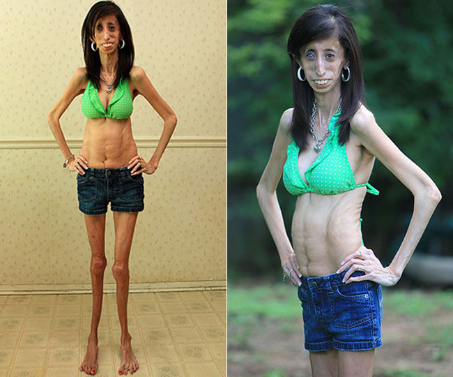 Lizzie Velasquez 21 tuổi, người Anh là một cô gái siêu gầy.